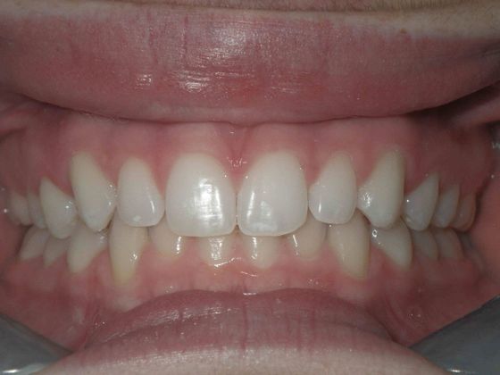 After Invisalign